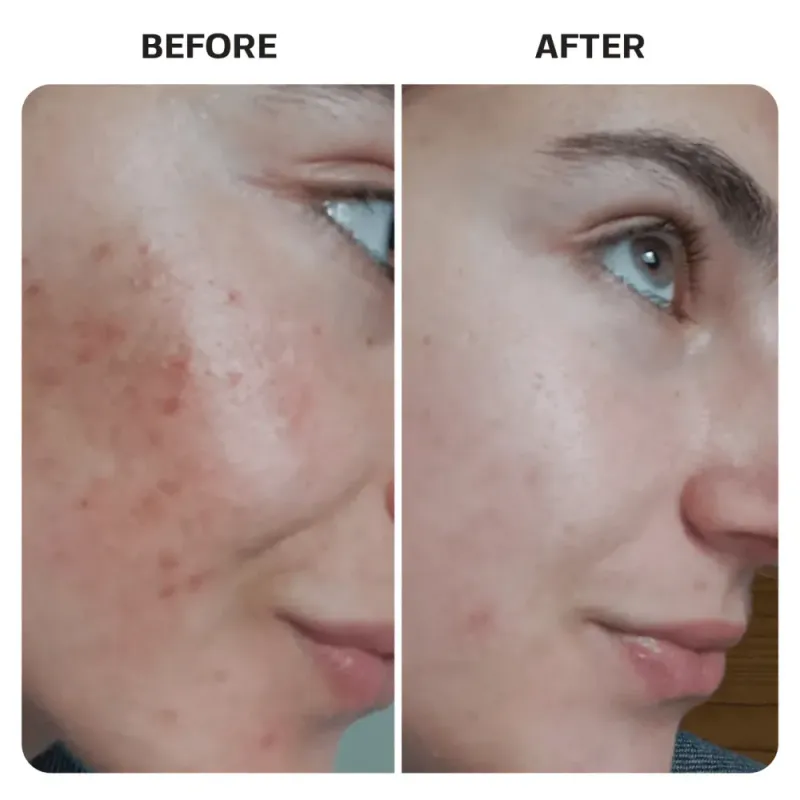 Piercing Bump Care Bundle