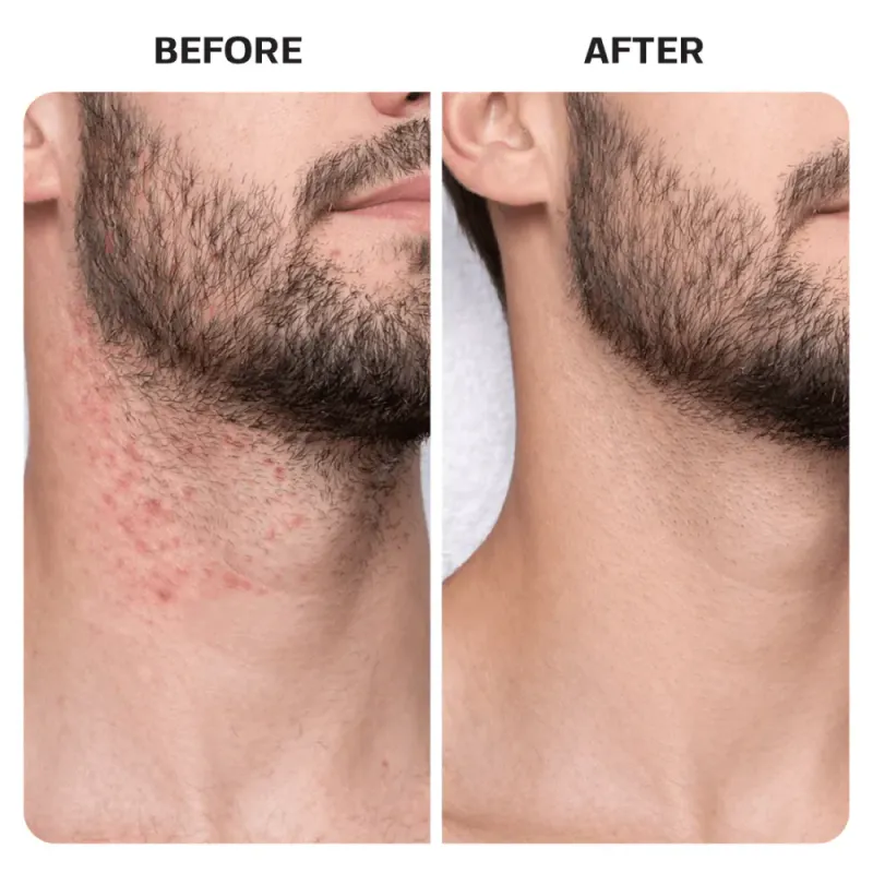 Ingrown Hair Treatment Pads