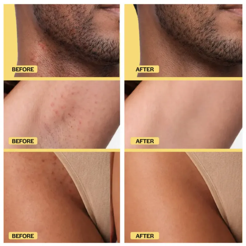 Ingrown Hair Roller Serum